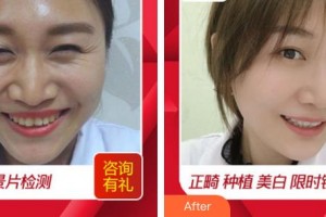 合肥麗人女子醫(yī)院中韓整形美容中心季媛梅 教授整形價(jià)格表附美白牙齒案例展示