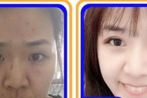 合肥大韓整形美容醫(yī)院郭健整形價(jià)格表附眼部綜合案例展示