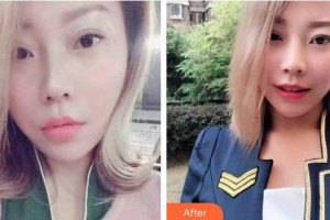 合肥愛春整形美容醫(yī)院范愛春整形價(jià)格表附牙齒隱形矯正案例展示