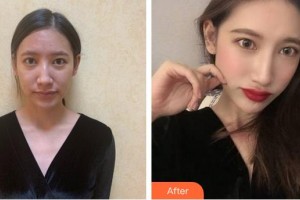 合肥大韓整形美容醫(yī)院申洪國整形價(jià)格表附肋軟骨隆鼻案例展示