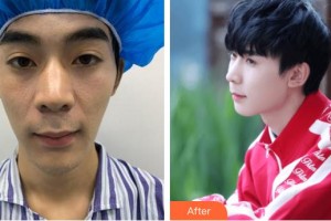 合肥申誠整形美容醫(yī)院魏有志整形價(jià)格表附鼻部綜合案例展示