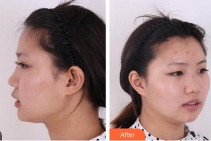 合肥申誠(chéng)整形美容醫(yī)院程淦整形價(jià)格表附鼻部綜合案例展示