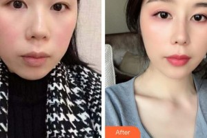 合肥博士整形外科醫(yī)院徐榮成整形價(jià)格表附耳軟骨復(fù)合隆鼻案例展示