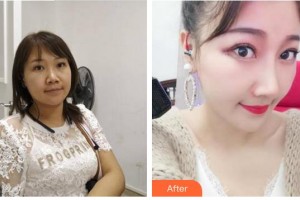 合肥崔勁松醫(yī)療美容診所崔勁松整形價(jià)格表附隆鼻案例展示