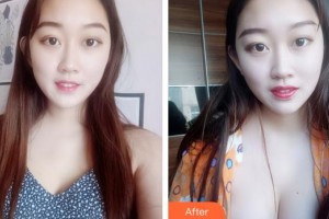 合肥第一人民醫(yī)院整形美容分院姚遠(yuǎn)整形價(jià)格表附自體脂肪隆胸案例展示