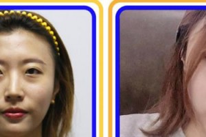 合肥劉大夫美容整形醫(yī)院徐鵬整形價(jià)格表附眼部綜合案例展示