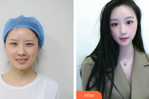 郴州韓雅醫(yī)療美容醫(yī)院王珂整形價(jià)格表附雙眼皮案例展示