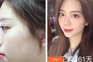 合肥大韓整形美容醫(yī)院張俊芳整形價(jià)格表附金屬托槽矯正案例展示