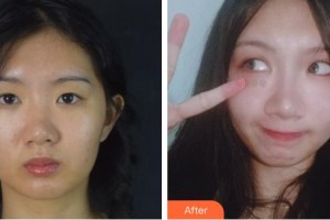 合肥愛春整形美容醫(yī)院傅賢德整形價(jià)格表附切開雙眼皮案例展示