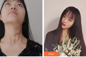 合肥大韓整形美容醫(yī)院梁雅娜整形價(jià)格表附激光祛疤案例展示