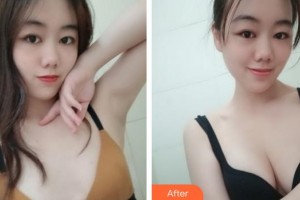 合肥丹鳳朝陽婦科醫(yī)院整形美容外科周蔚整形價(jià)格表附自體脂肪隆胸案例展示