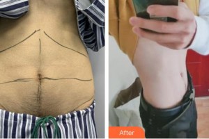 合肥丹鳳朝陽婦科醫(yī)院整形美容外科李長(zhǎng)富整形價(jià)格表附腰腹吸脂案例展示