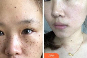 合肥丹鳳朝陽婦科醫(yī)院整形美容外科李淑珂整形價(jià)格表附祛斑案例展示