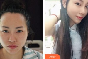 合肥凱美醫(yī)療美容醫(yī)院李立國(guó)整形價(jià)格表附肋軟骨隆鼻案例展示