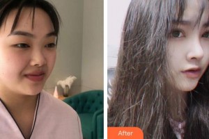 合肥凱美醫(yī)療美容醫(yī)院胡啟能整形價(jià)格表附眼部修復(fù)案例展示