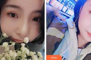 合肥艾雅整形美容醫(yī)院吳宇萌整形價(jià)格表附牙齒隱形矯正案例展示