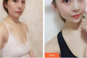 合肥天鵝湖整形美容醫(yī)院康學(xué)培整形價格表附自體脂肪隆胸案例展示