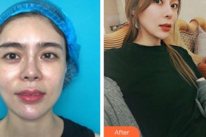 合肥福華醫(yī)療美容醫(yī)院楊富春整形價格表附眼部綜合案例展示