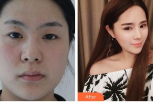 合肥臺美醫(yī)療美容門診部莊堅文整形價格表附雙眼皮案例展示