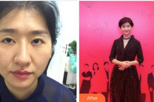 合肥童顏堂醫(yī)療美容醫(yī)院閆美華整形價格表附眼部修復(fù)案例展示