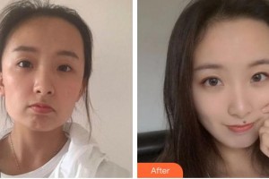 合肥臺美醫(yī)療美容門診部羅世恩整形價格表附埋線提升案例展示