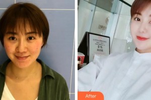 合肥臺美醫(yī)療美容門診部陳宏榮整形價格表附埋線提升案例展示
