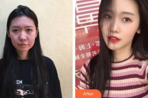 合肥光美醫(yī)療整形美容醫(yī)院張杰整形價格表附埋線提升案例展示