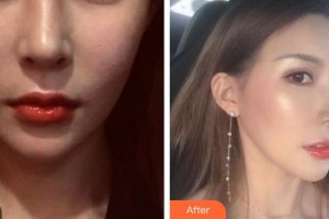 合肥光美醫(yī)療整形美容醫(yī)院尹芳整形價格表附熱瑪吉案例展示