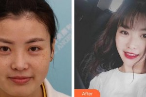 合肥光美醫(yī)療整形美容醫(yī)院田莉整形價格表附激光美膚激光案例展示