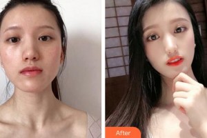 合肥光美醫(yī)療整形美容醫(yī)院周家琴整形價格表附激光美膚激光案例展示