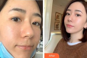 合肥光美醫(yī)療整形美容醫(yī)院范梅整形價格表附激光美膚激光案例展示