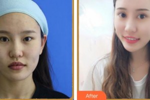 合肥凱美醫(yī)療美容醫(yī)院柳重錫整形價格表附眼部綜合案例展示