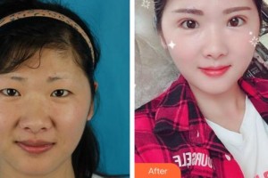 合肥臺美醫(yī)療美容門診部劉建龍整形價格表附切開雙眼皮案例展示