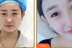 合肥艾雅整形美容醫(yī)院楊海平整形價格表附眼部綜合案例展示