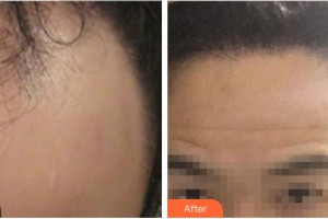 合肥源森美容整形外科診所周芳整形價格表附發(fā)際線案例展示