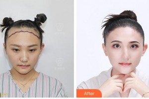 合肥源森美容整形外科診所曹守己整形價格表附種植發(fā)際線案例展示