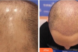 合肥叢生醫(yī)療美容門診部王順霞整形價格表附頭頂加密種植案例展示