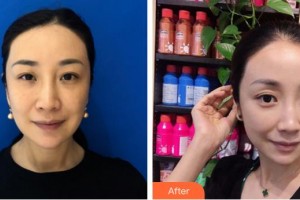 合肥美舒雅醫(yī)療美容診所王軍整形價格表附埋線提升案例展示
