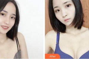 合肥美舒雅醫(yī)療美容診所席慶春整形價格表附自體脂肪隆胸案例展示