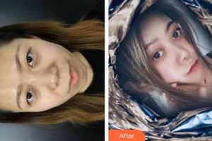 合肥玉顏醫(yī)療美容門診部周瑜整形價格表附切開雙眼皮案例展示