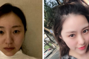 西安貝巢口腔診所張錦鴿整形價(jià)格表附眼部綜合案例展示