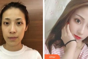 合肥名人眼科醫(yī)院朱美玲整形價格表附眼部綜合案例展示