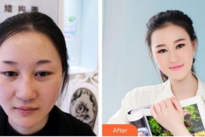 江蘇百年植發(fā)醫(yī)院王燦領(lǐng)整形價格表附植發(fā)案例展示