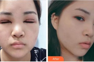 合肥名人眼科醫(yī)院劉紅整形價格表附眼部綜合案例展示