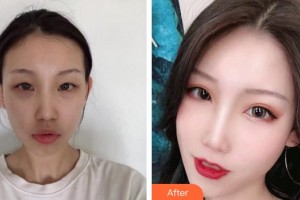 合肥名人眼科醫(yī)院張照珍整形價格表附眼部綜合案例展示