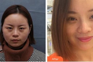 合肥名人眼科醫(yī)院岳春整形價格表附重瞼修復術+上瞼提肌矯正術案例展示