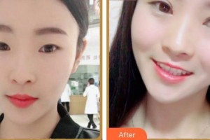 合肥愛爾眼科醫(yī)院王志剛整形價格表附眼部綜合案例展示