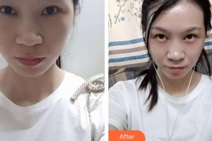 合肥愛爾眼科醫(yī)院朱華美整形價格表附眼部修復案例展示