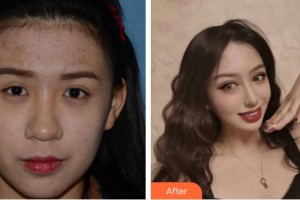 合肥愛爾眼科醫(yī)院陳國府整形價格表附眼部綜合案例展示