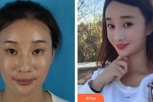 合肥愛爾眼科醫(yī)院劉帥帥整形價格表附眼部整形案例展示